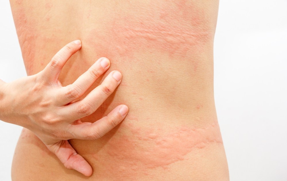 Giải Pháp Làm Khô Quần Áo Nhanh Chóng Những Ngày Mưa Dài 3 Mặc quần áo ẩm gây kích ứng da